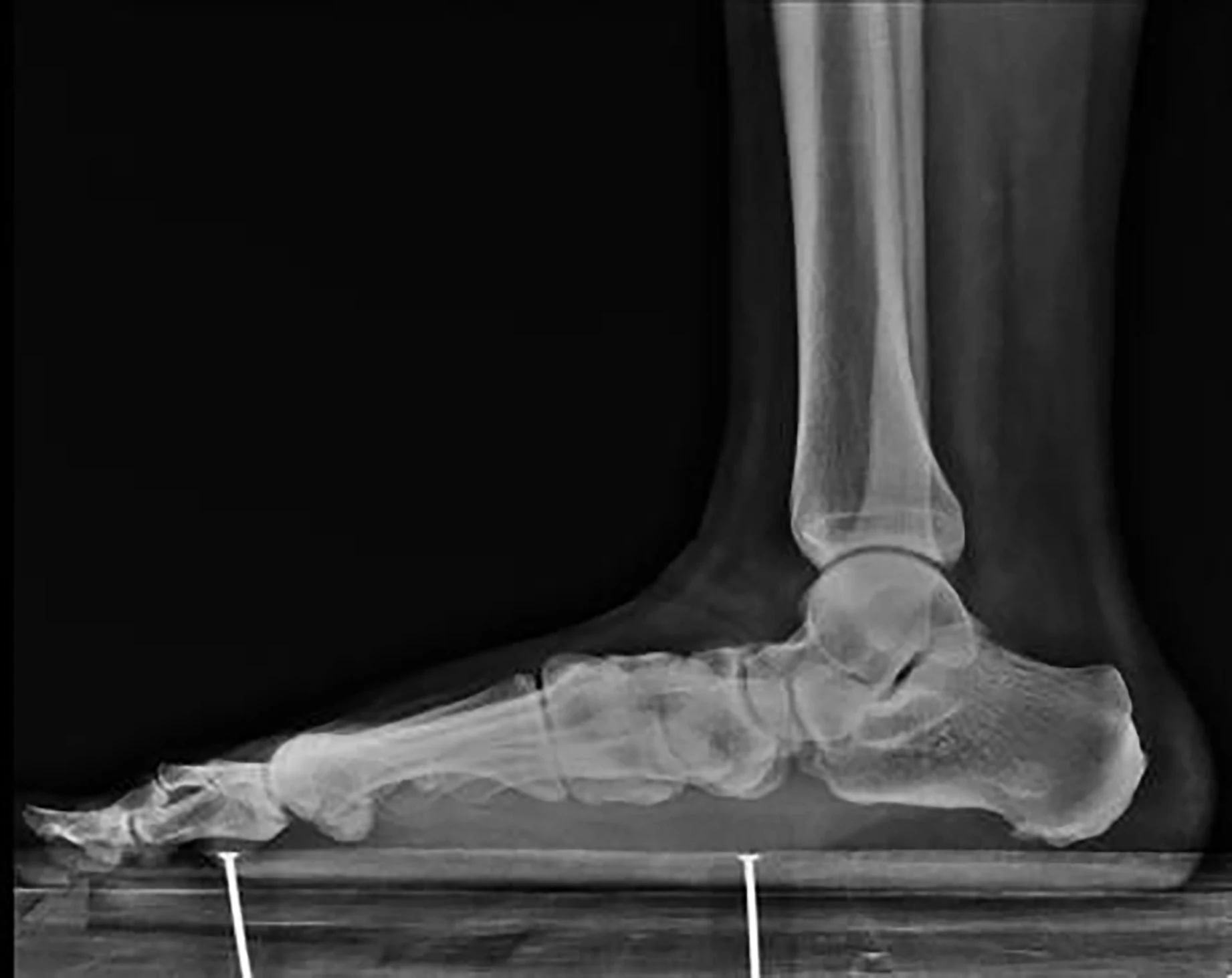 MRI for flat feet 
