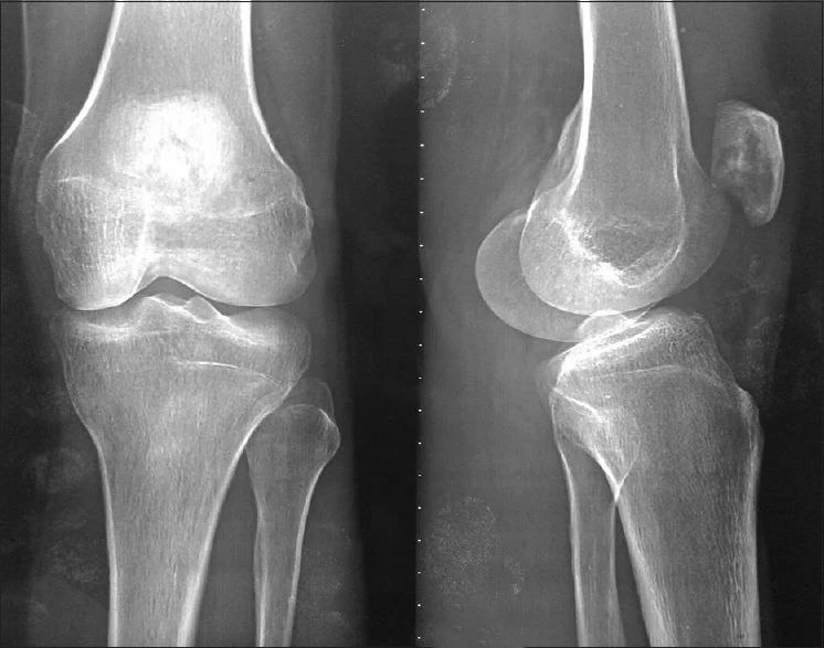 X-ray image, anteroposterior and lateral view of the knee showing a degenerative lesion of the patella surrounded by sclerotic bone.