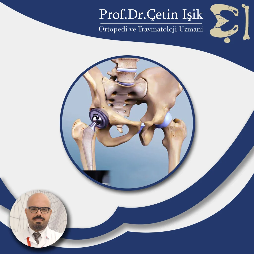 Treatment of diseases of the hip joint by Dr. Cetin Isik