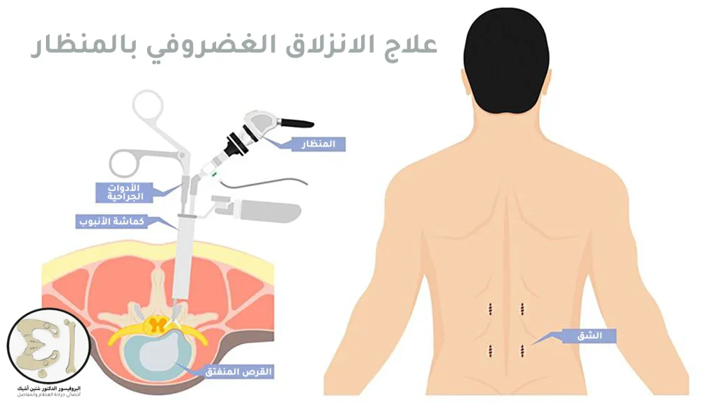 تظهر الصورة كيفية جراحة الانزلاق الغضروفي باستخدام منظار وإجراء شق جراحي صغير.