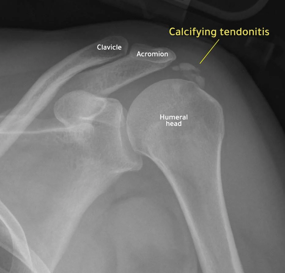 X-rays show calcification of the rotator cuff tendon 