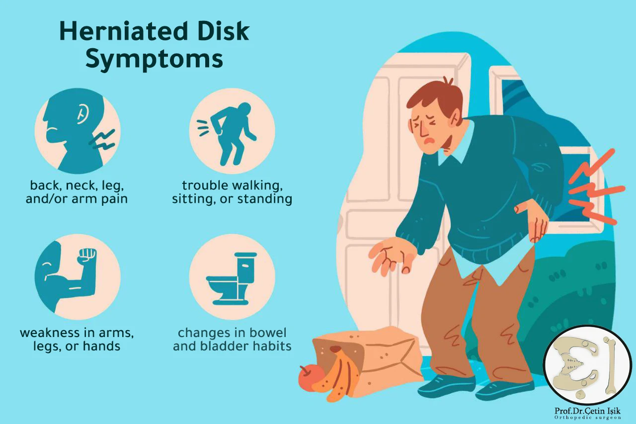 An enumeration of the symptoms of a herniated disc, including disorders in walking and sitting, change in exit habits, weakness in the legs and arms, and pain in the neck, leg and back.