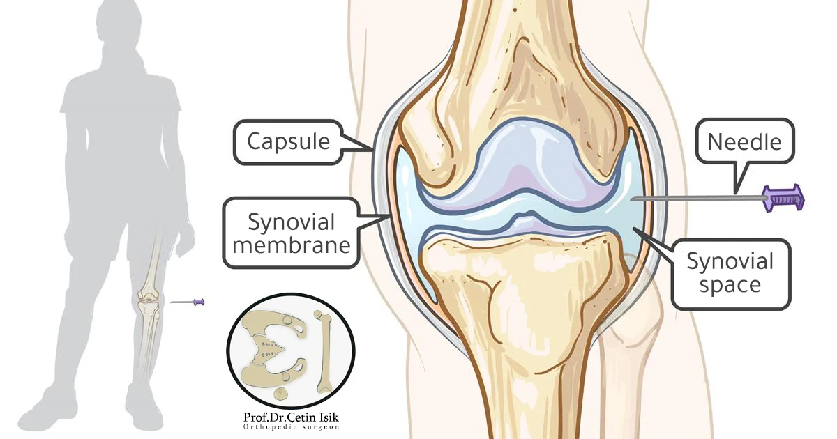 Joint pain can be relieved by injecting medications such as steroids and hyaluronic acid into the joint