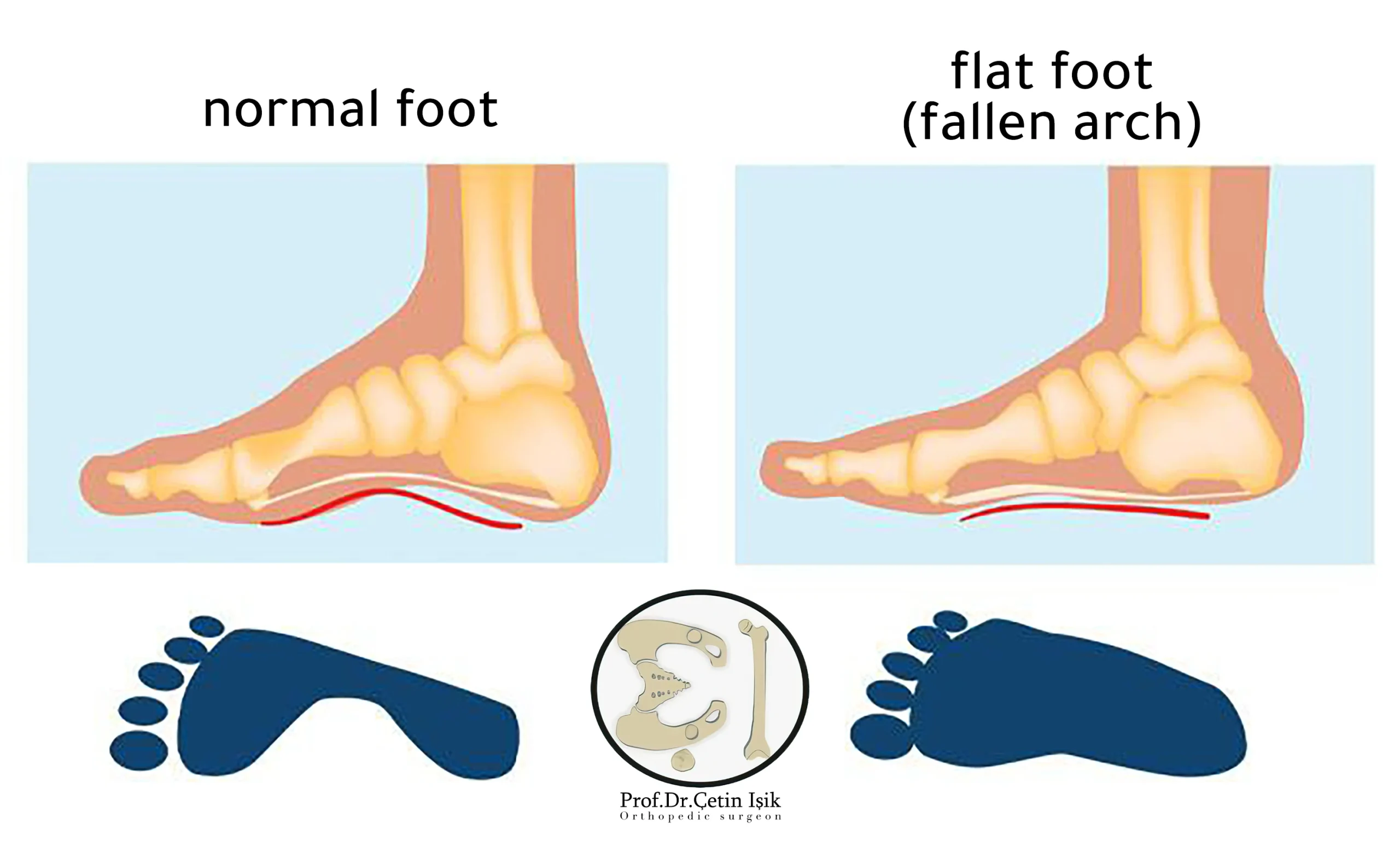 The difference between normal foot and flat foot and their footprint
