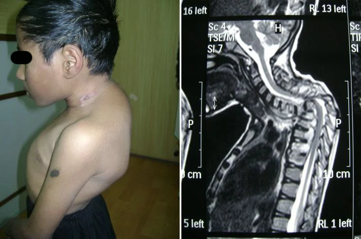 Curvature of the back in a child with tuberculosis of the spine.