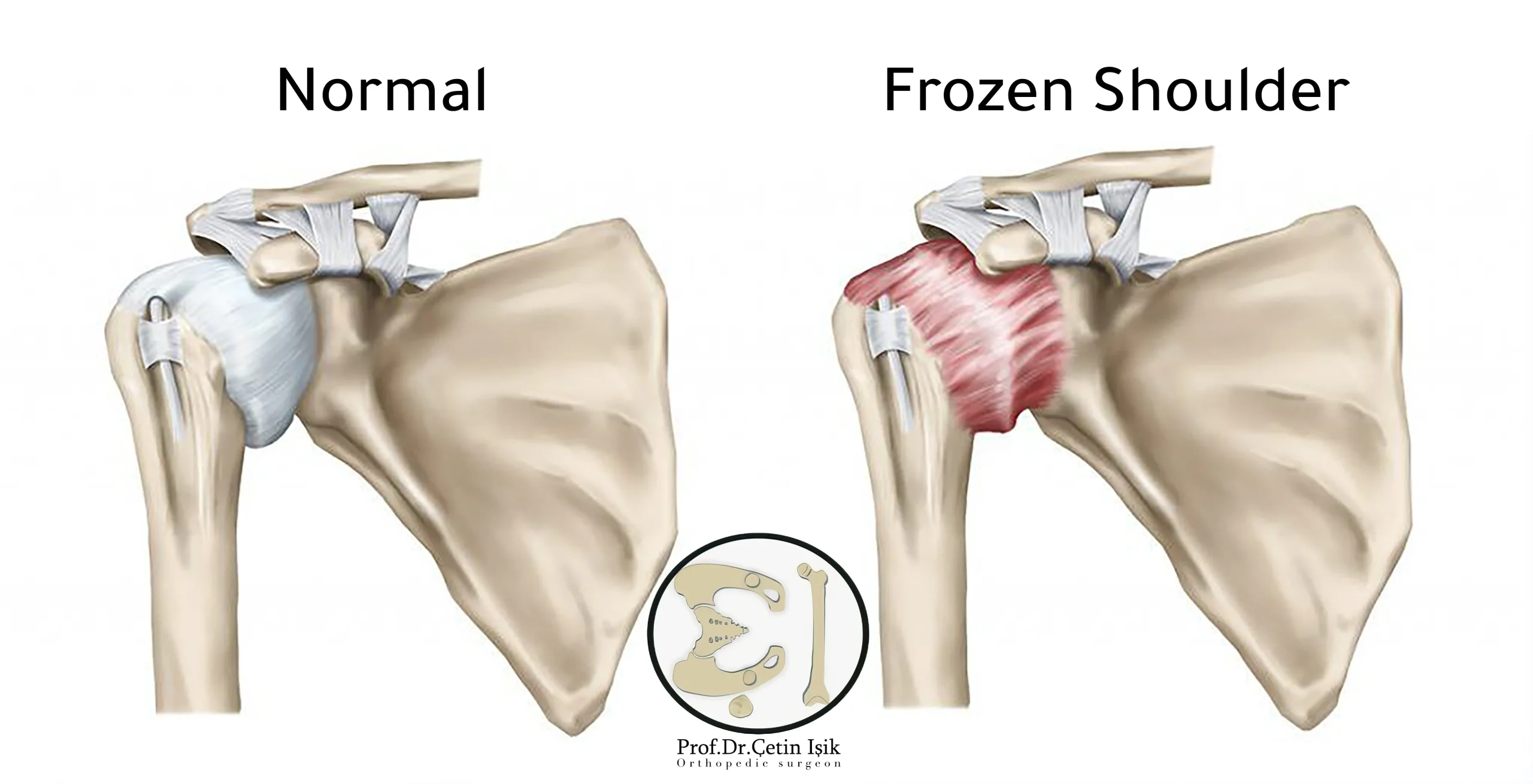 The difference between a normal shoulder and a frozen shoulder, we note the formation of scar tissue in the shoulder joint in the case of frozen shoulder