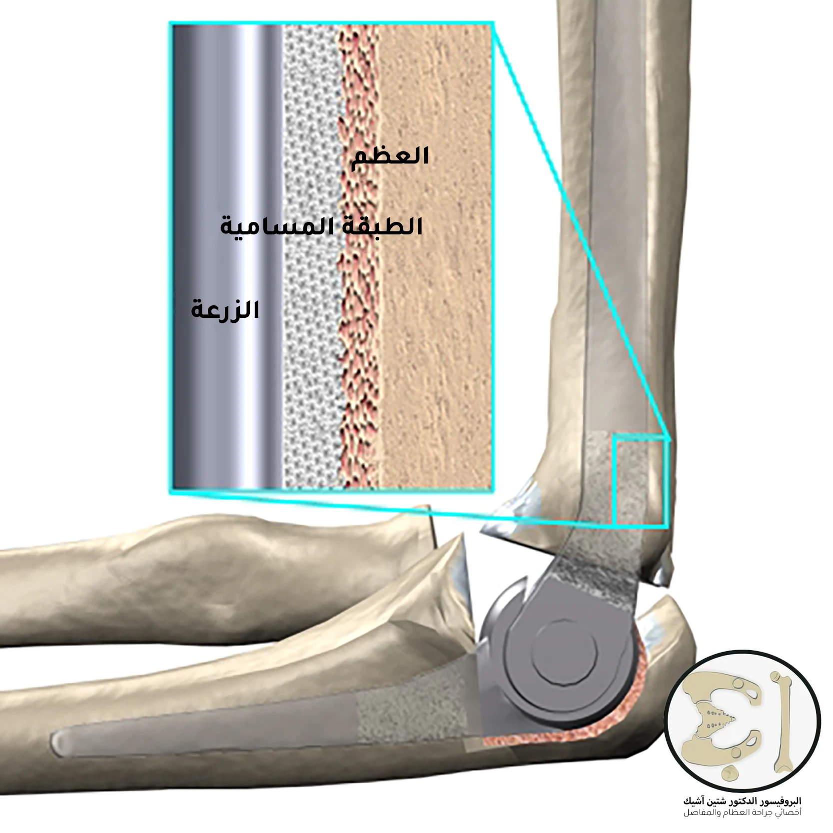 A picture showing the placement of the artificial elbow joint