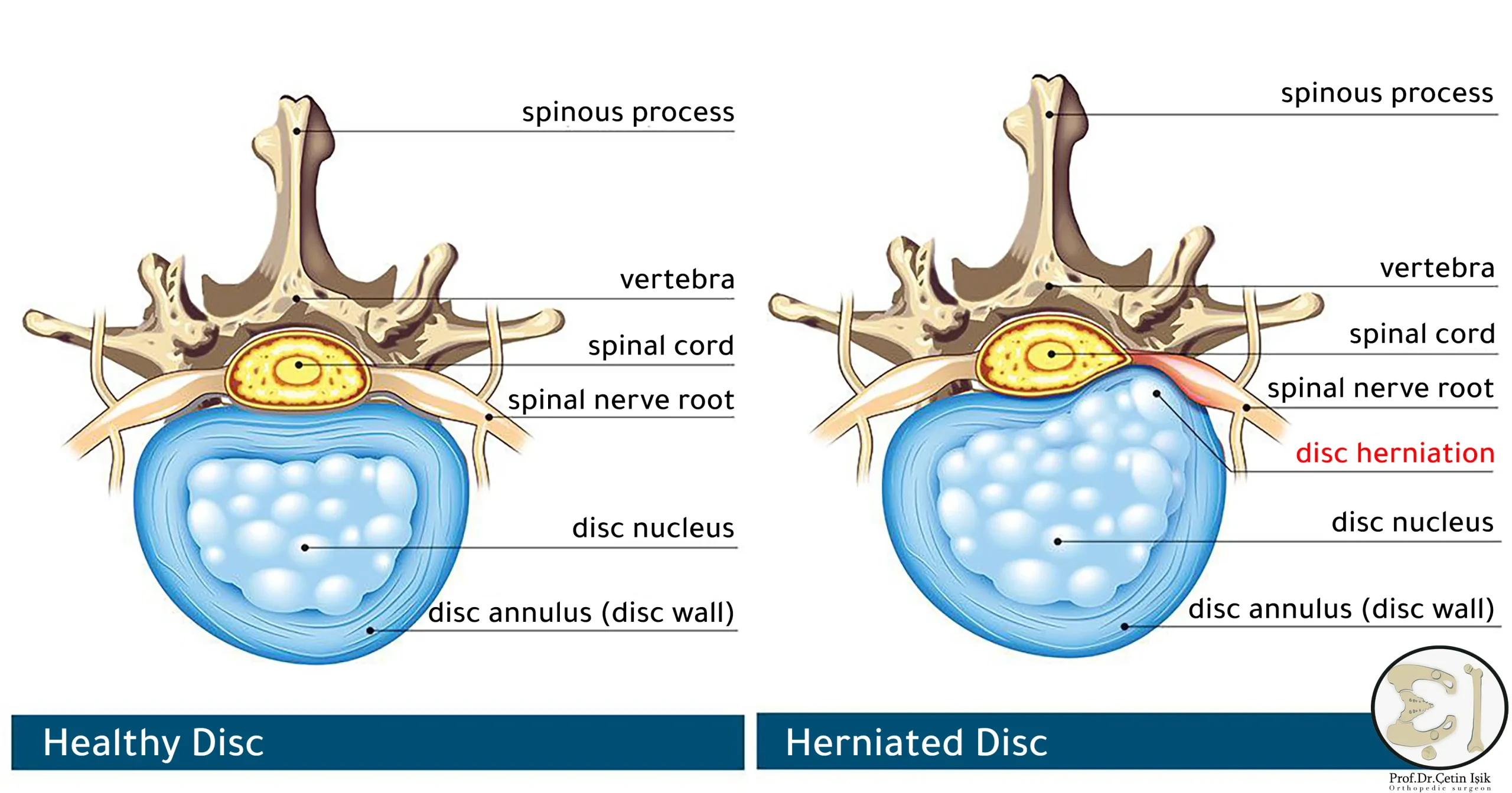 The difference between a herniated disc and a healthy disc, we note the protrusion of the nucleus of the disc outside the outer fibrous wall