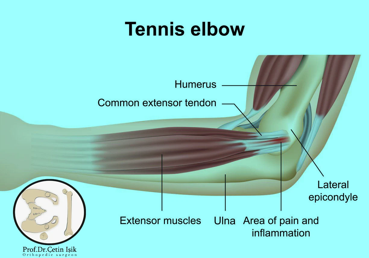 A picture showing the elbow joint and the location of the tennis elbow injury.