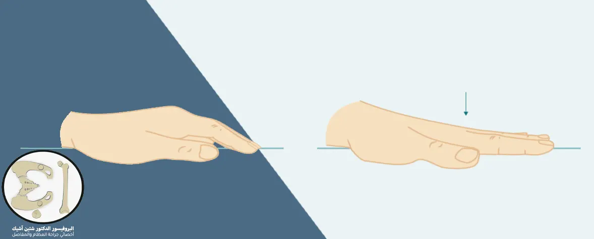 يتم إجراء تمرين تمطيط الأصابع عبر وضع اليد على سطح مستوي وجعل راحة اليد ملامسة لهذا السطح وتمديد الأصابع قدر الإمكان