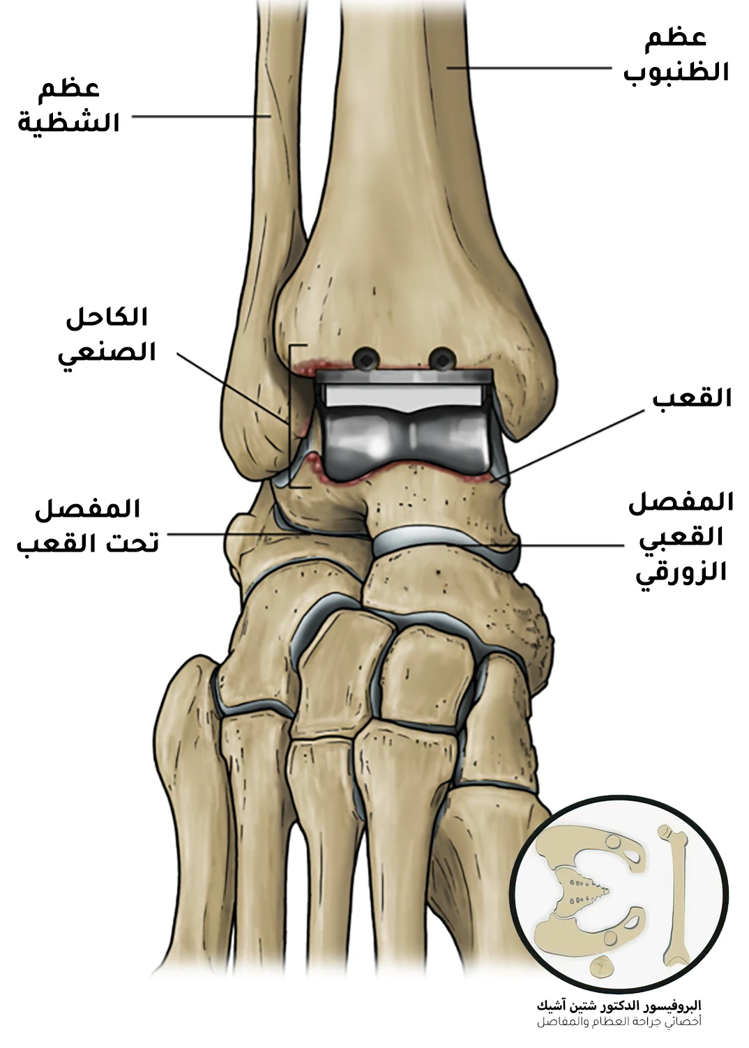 صورة توضح مفصل القدم الاصطناعي بعد تركيبه