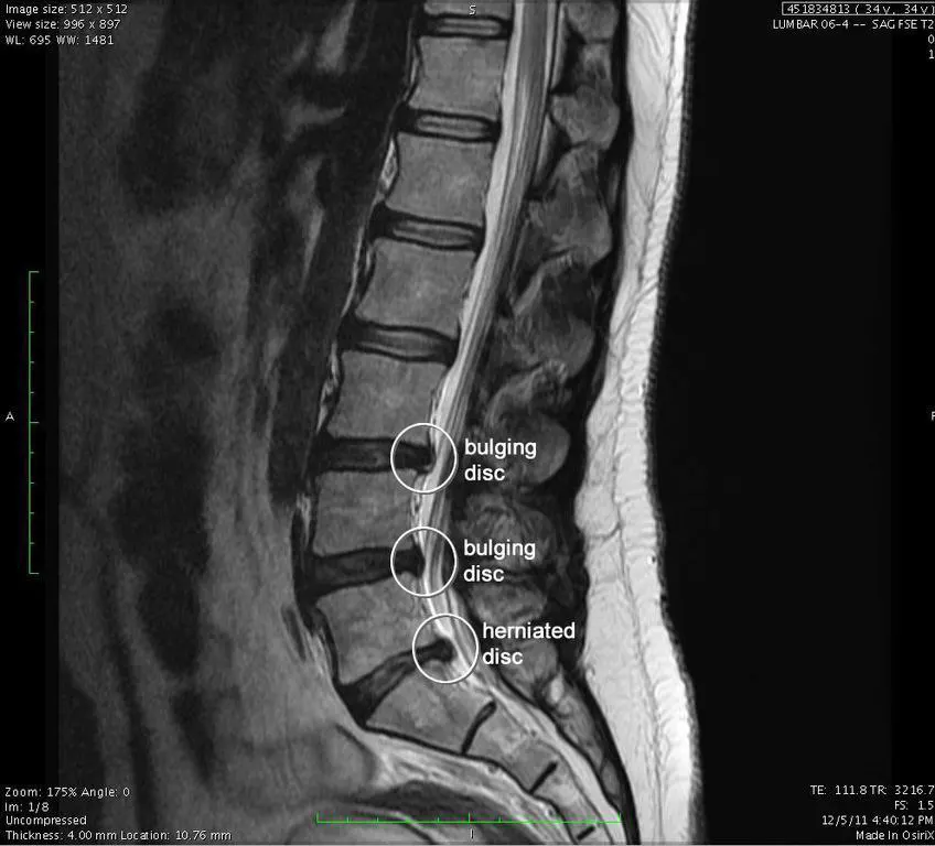 Magnetic resonance imaging (MRI) showing a herniated disc in the lumbar spine and a ruptured disc