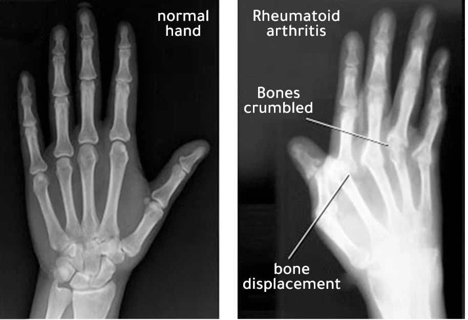 A radiograph showing the difference between a healthy hand and a hand affected by rheumatoid arthritis