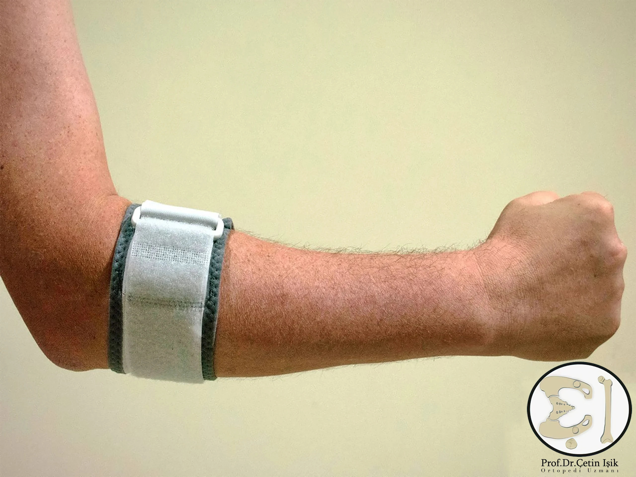 An opposite force splint used in the treatment of tennis elbow.