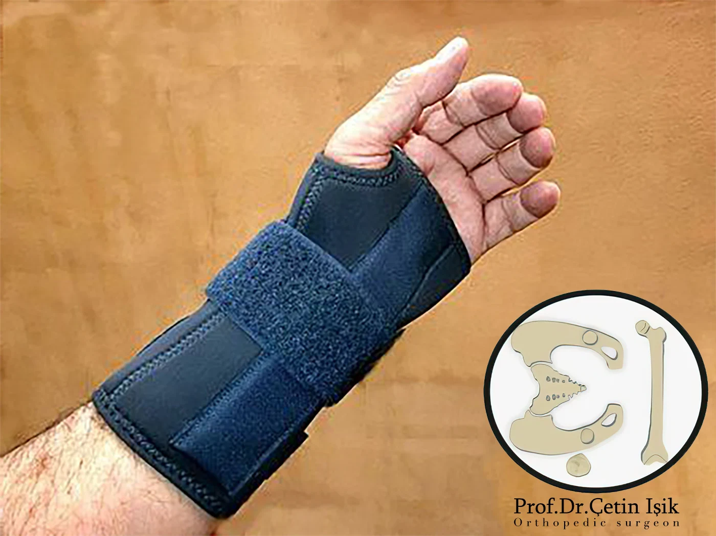 A wrist extension splint is used for the elbow of a tennis player.