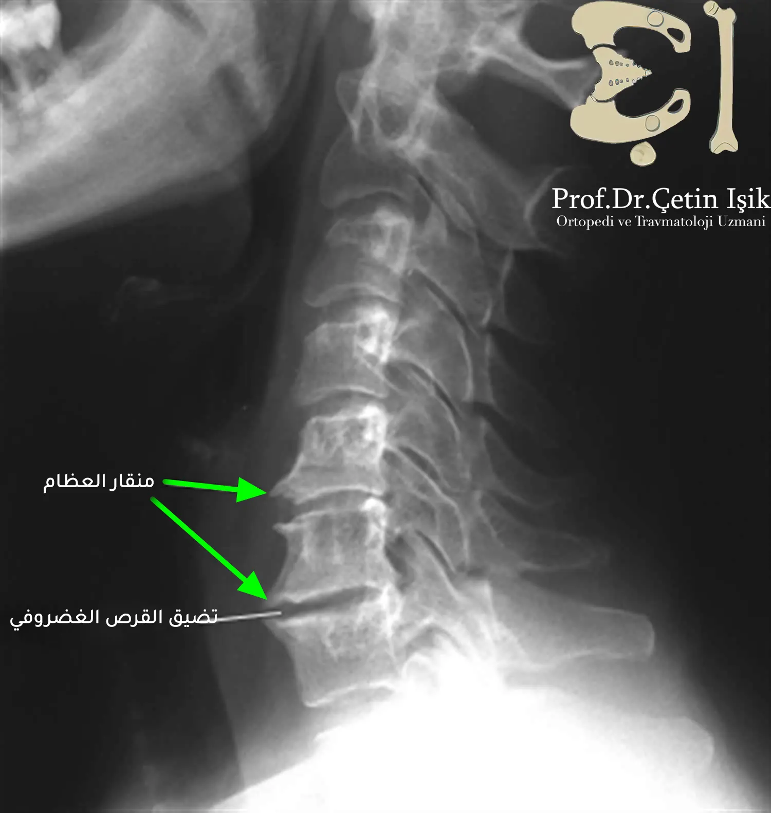 Radiograph showing neck spurs disease