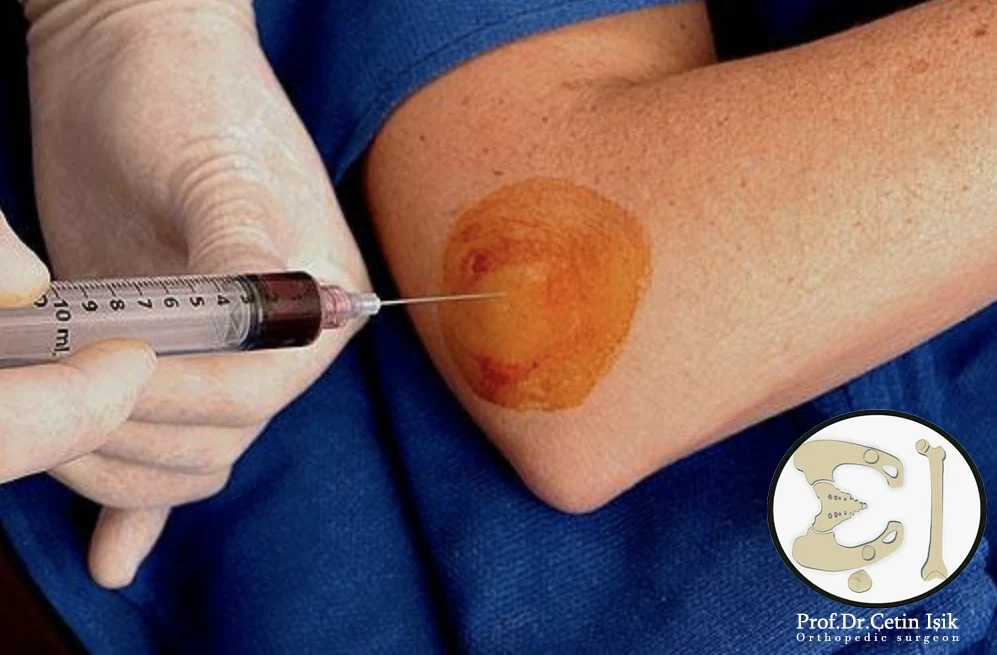 Treating tennis elbow by injecting PRP into the injured area.