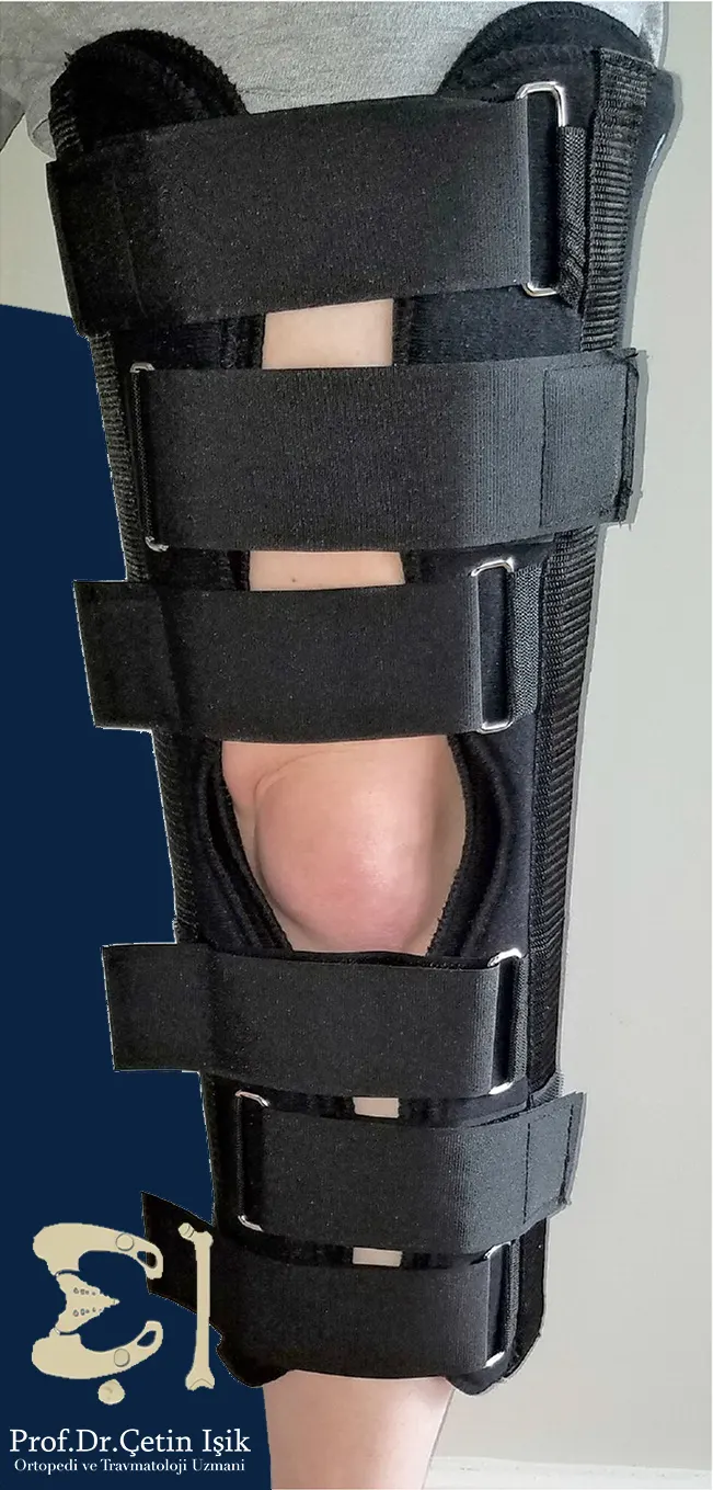 صورة توضح الرباط المثبت للركبة ويستعمل بشكل شائع بعد الكسور والعمليات