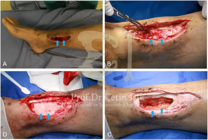 Clips during osteoporosis, in which antibiotic-laden dressings were applied and a flap was used to cover the soft tissues.