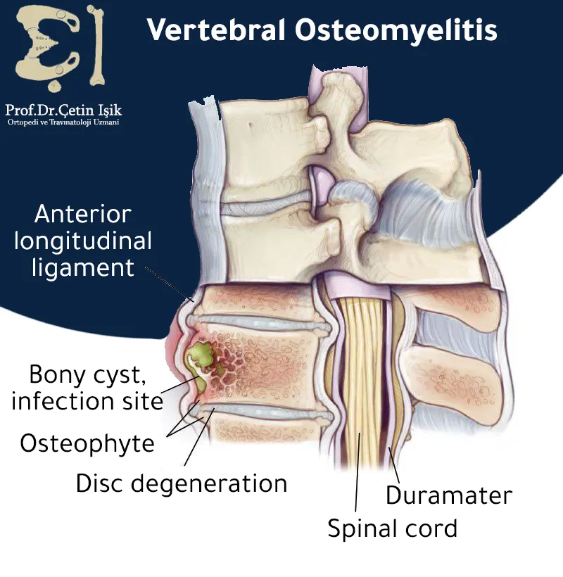Illustrative image describing the formation of a cyst in the spine and its inflammatory effect on the surrounding tissues