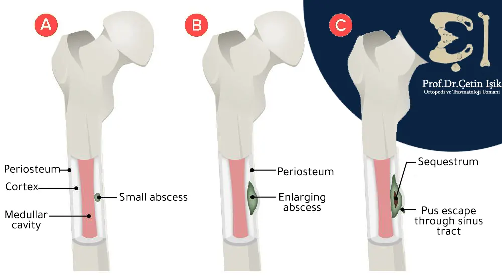 The stages of osteomyelitis are from the formation of a small abscess inside the bone marrow cavity until its expansion and spread outside the bone cortex, cutting off the blood supply.