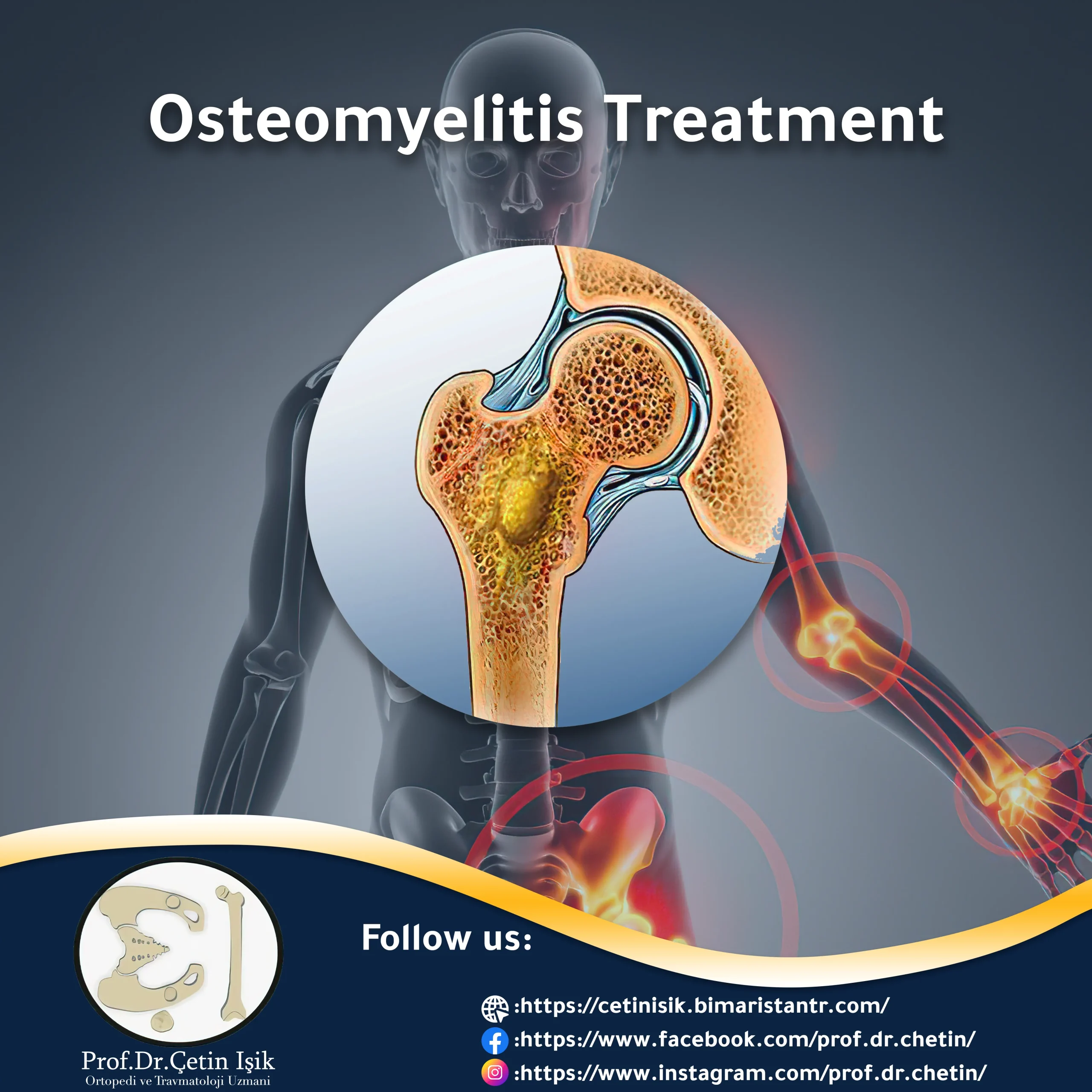 Osteomyelitis treatment