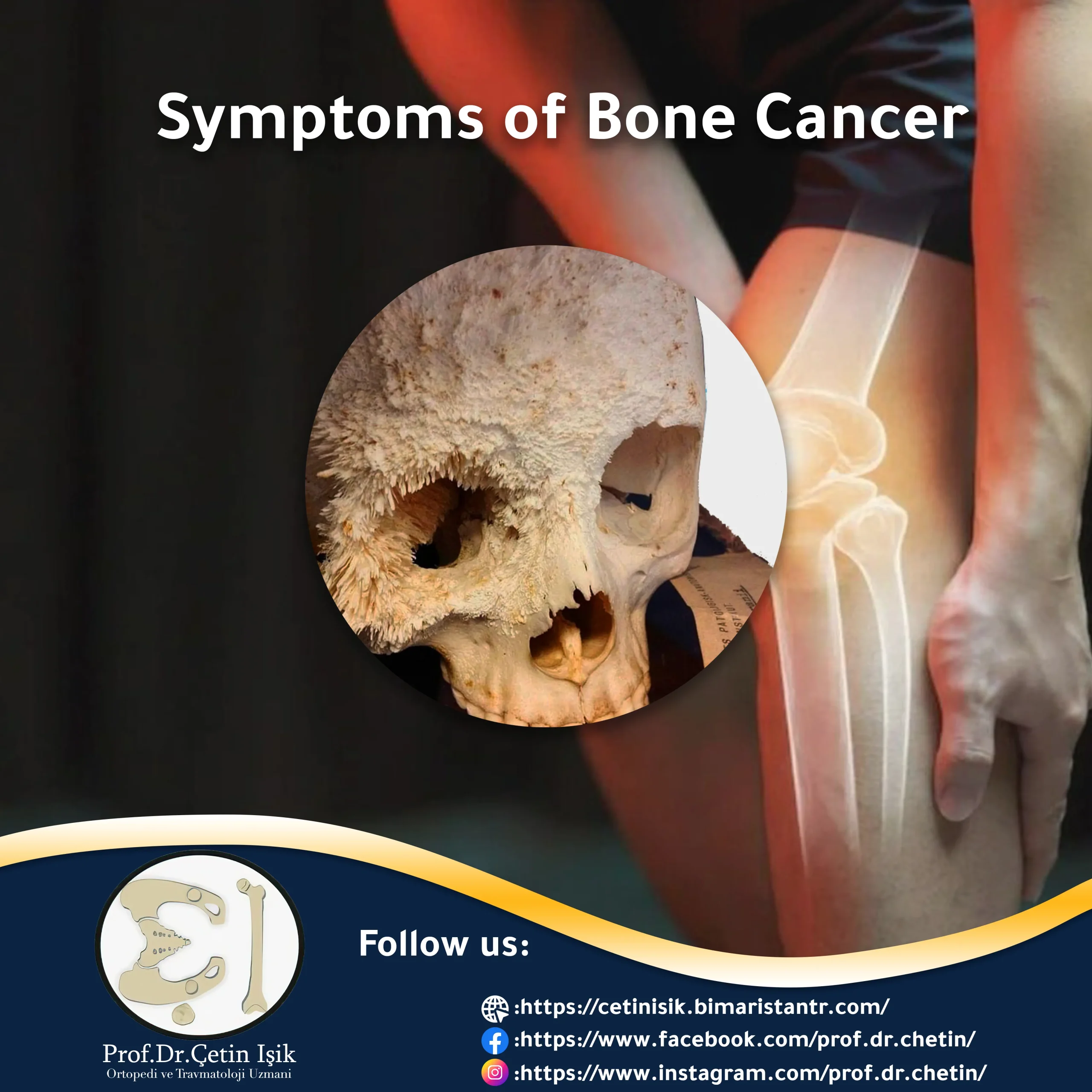 Image showing bone cancer metastasizing to the skull bone.