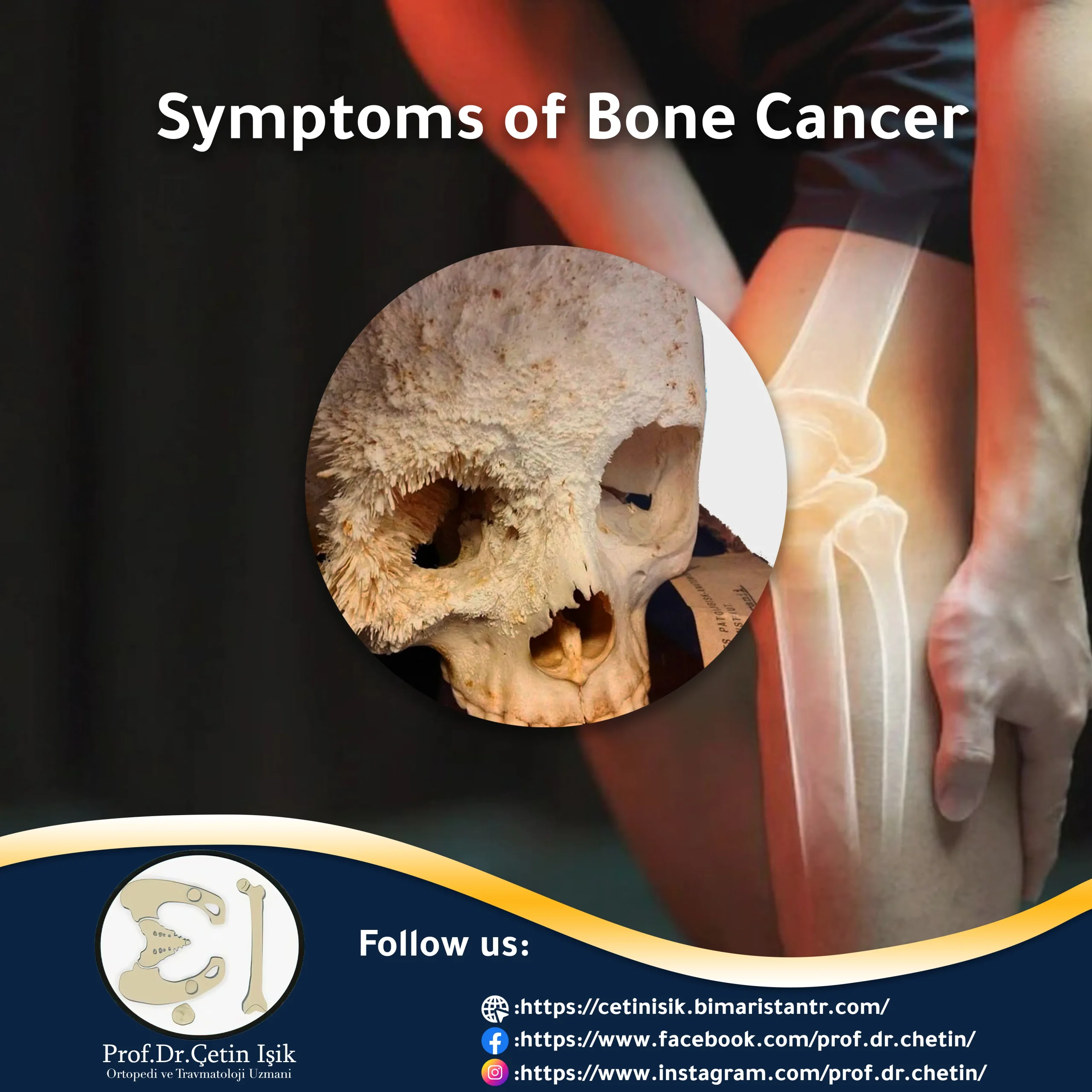 Symptoms Of Bone Cancer Prof Dr etin I k