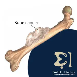 Bone cancer in the thigh bone