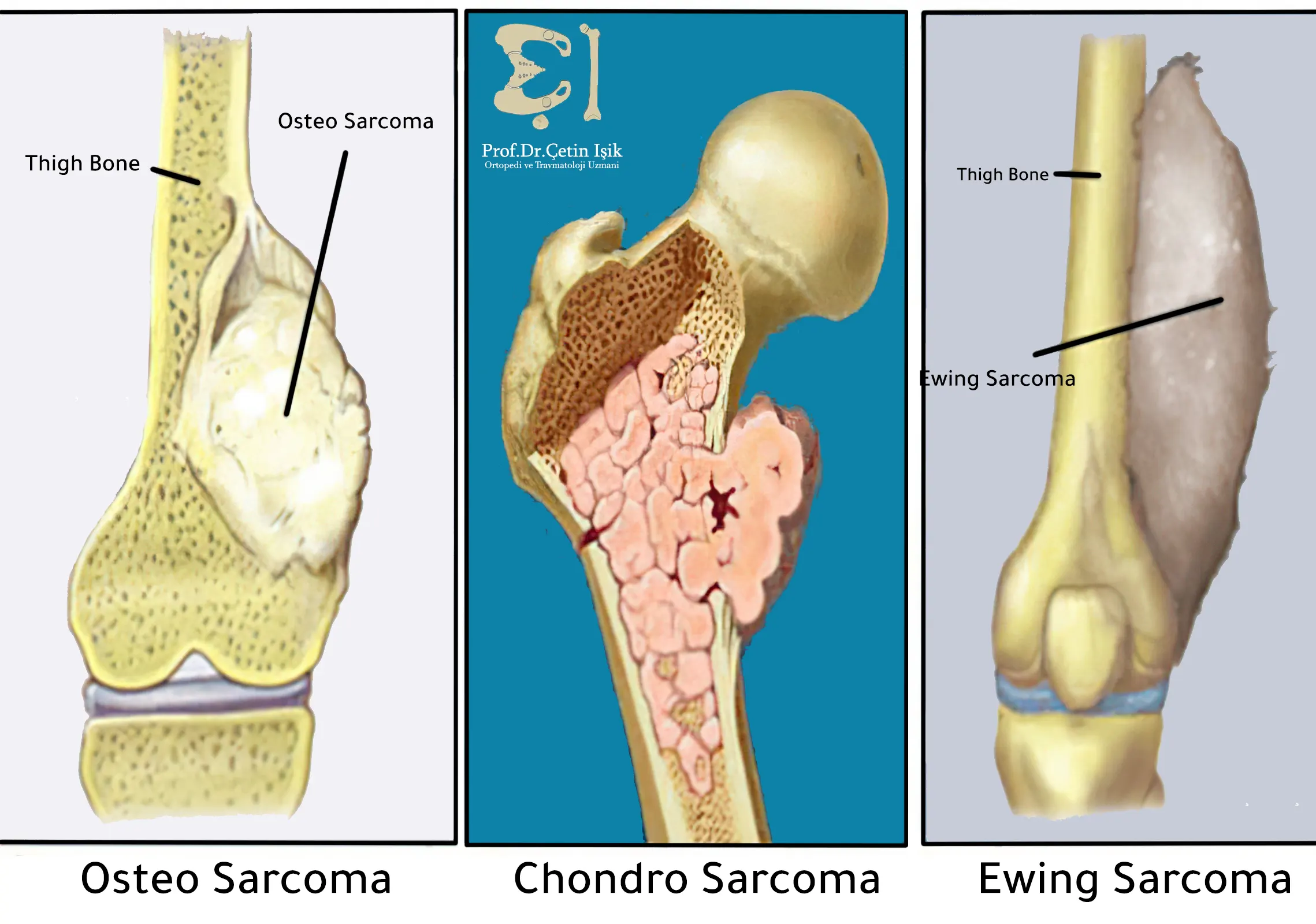 An image showing the primary types of bone cancer