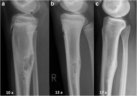 Radiograph showing bone cancer in the tibia that may have metastasized from another location.