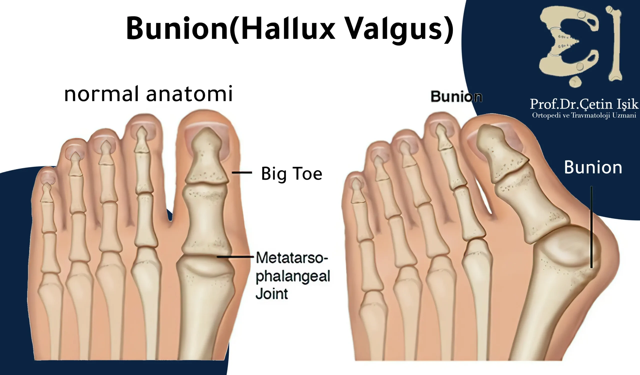 Difference between normal and hallux valgus foot