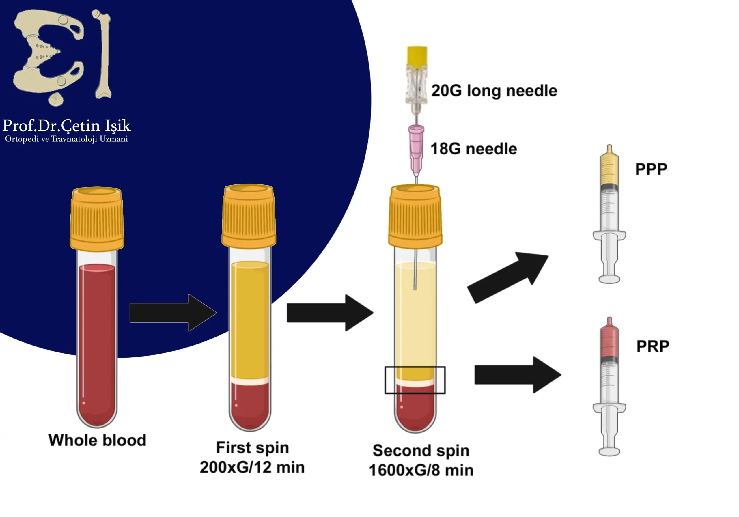 Image showing the method of preparing plasma to obtain platelet rich plasma 