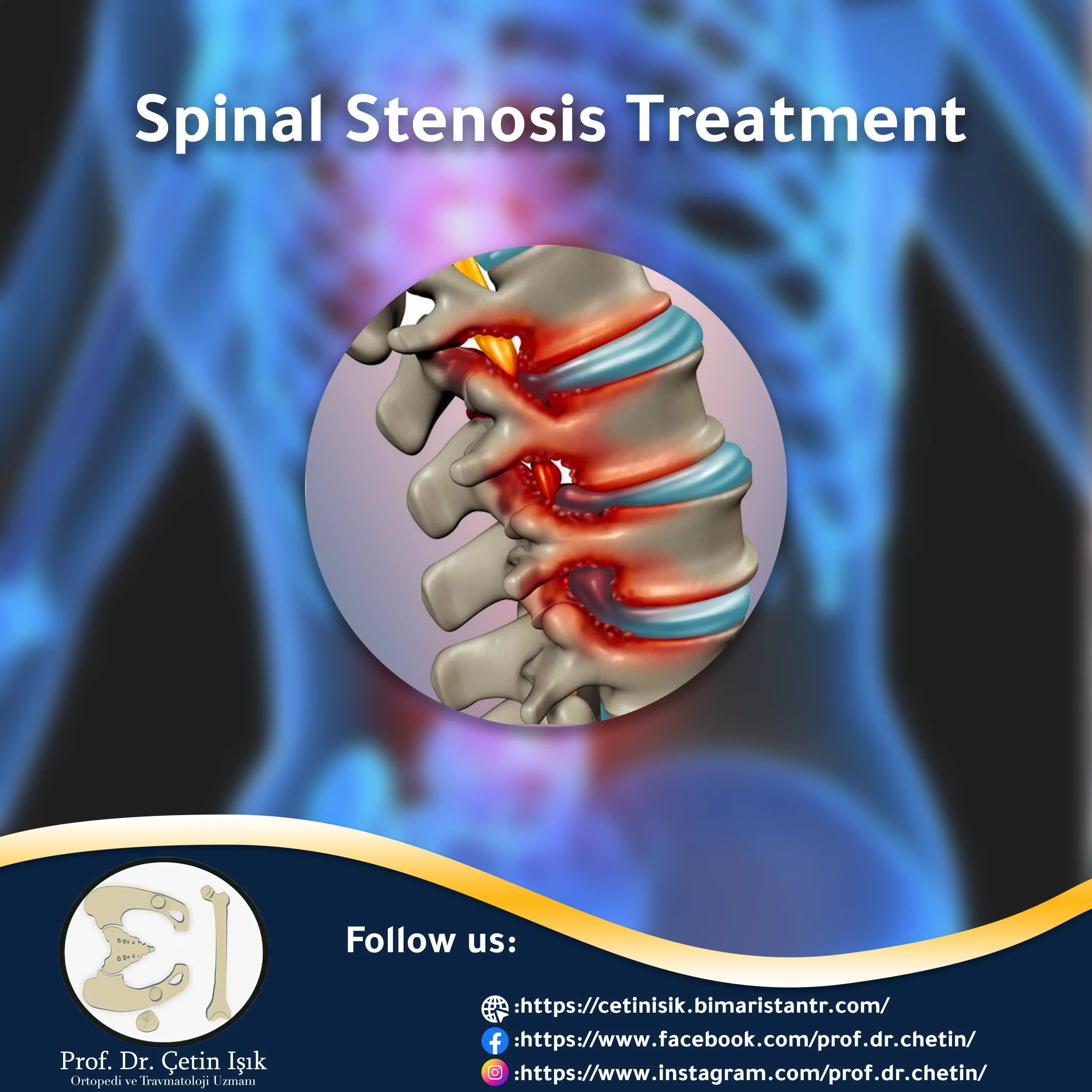 Spinal stenosis treatment article