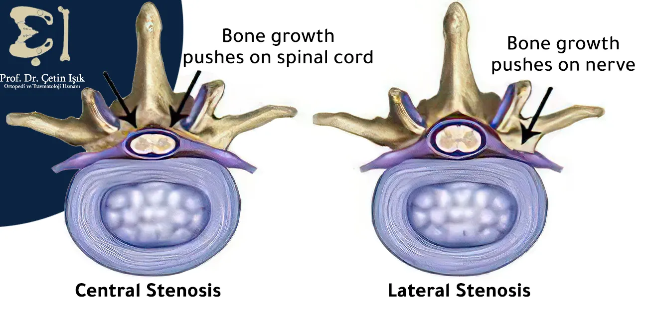 The illustration shows the difference between central stenosis pressing on the spinal cord and lateral stenosis pressing on the spinal nerve