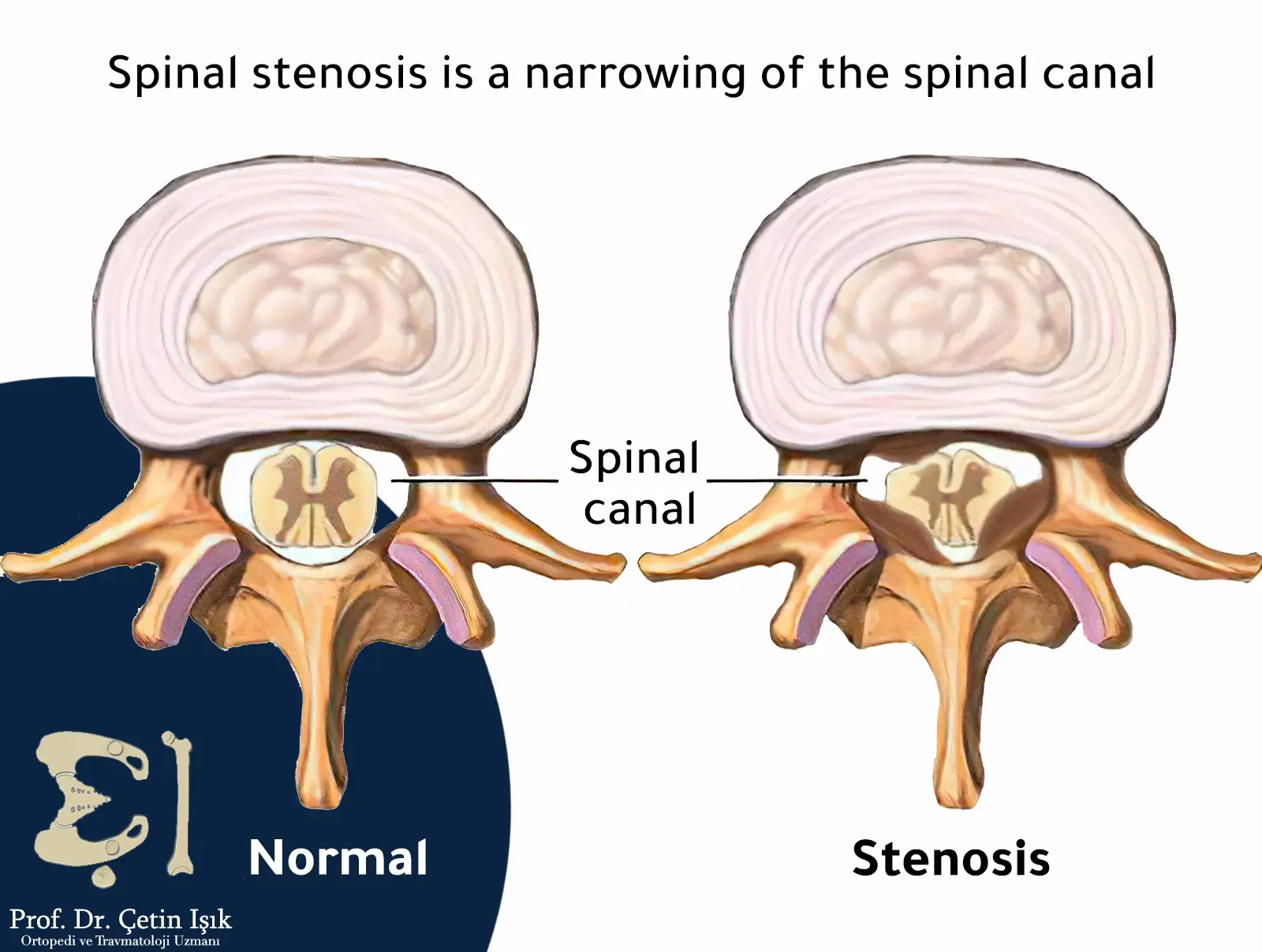 The difference between a normal vertebra and a narrowed vertebra in the spine