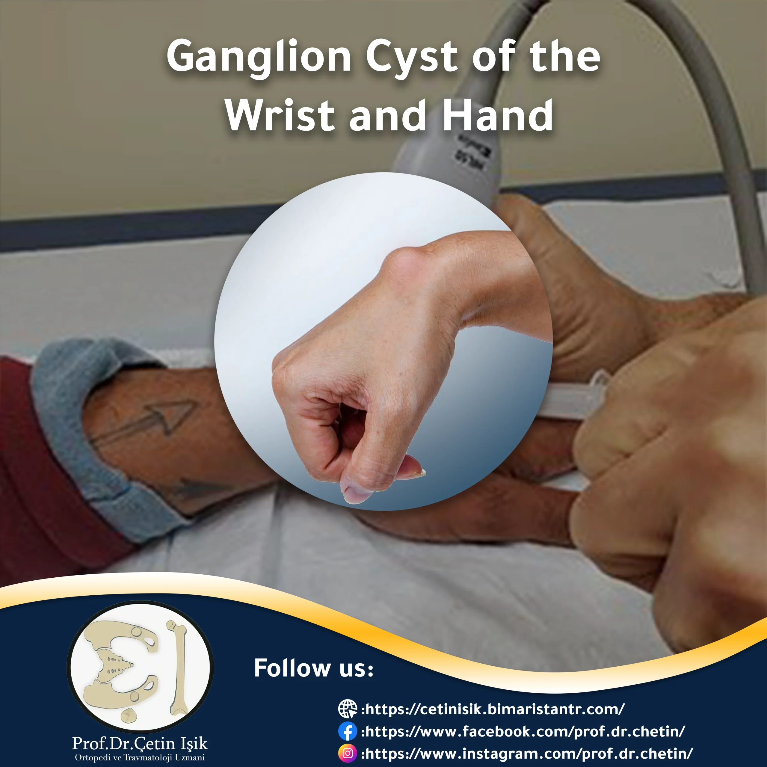 Ganglion cyst in hand article photo