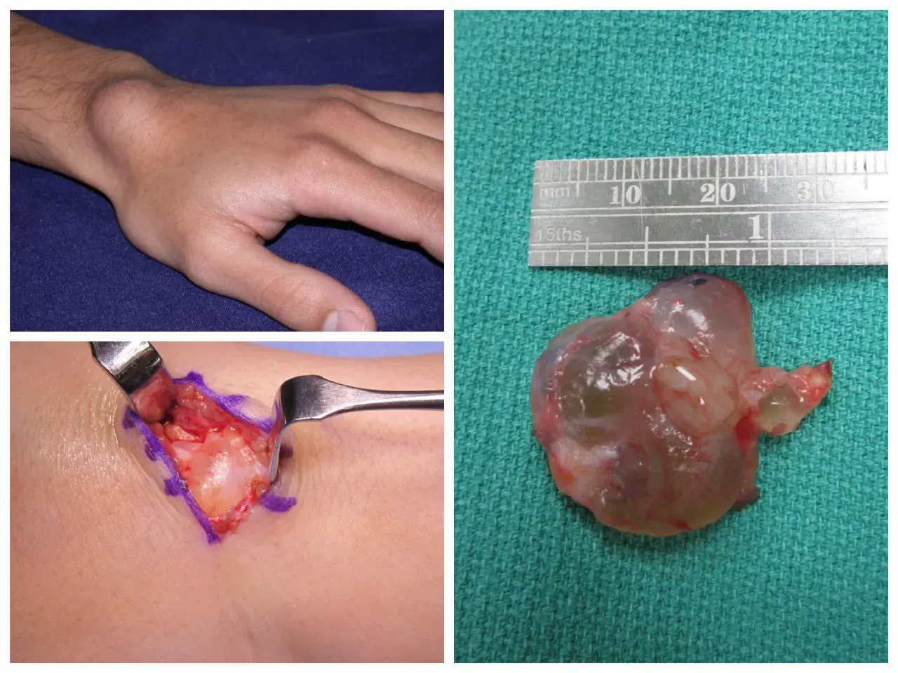 The image shows a ganglion cyst after surgical removal