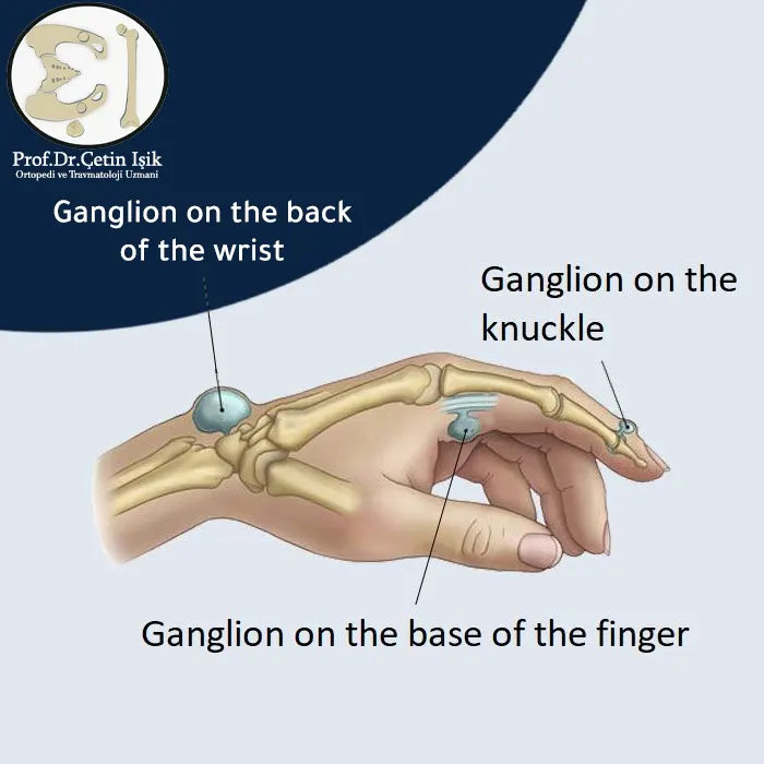 The image shows where ganglion cysts form on the hand