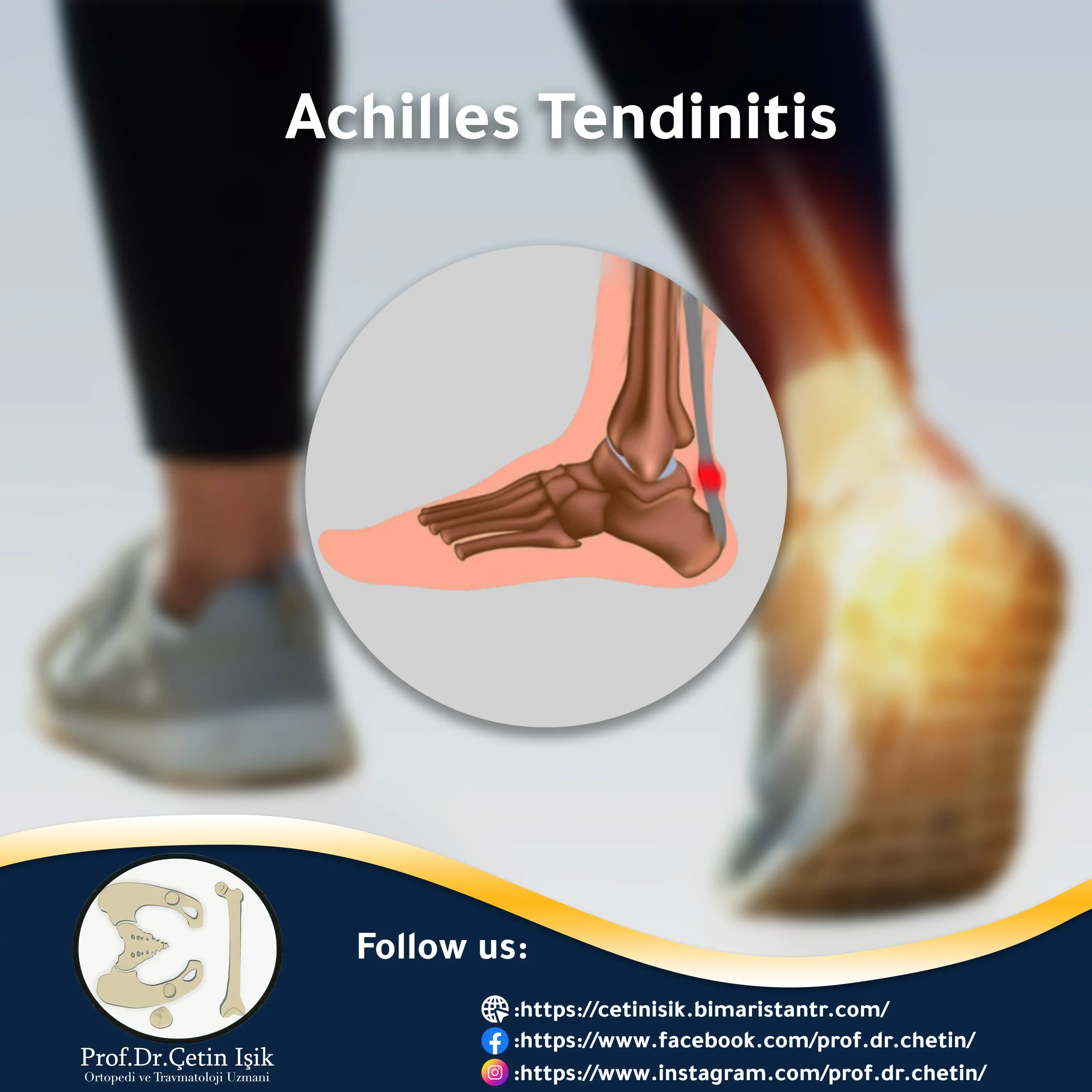 Picture of an article about Achilles tendonitis