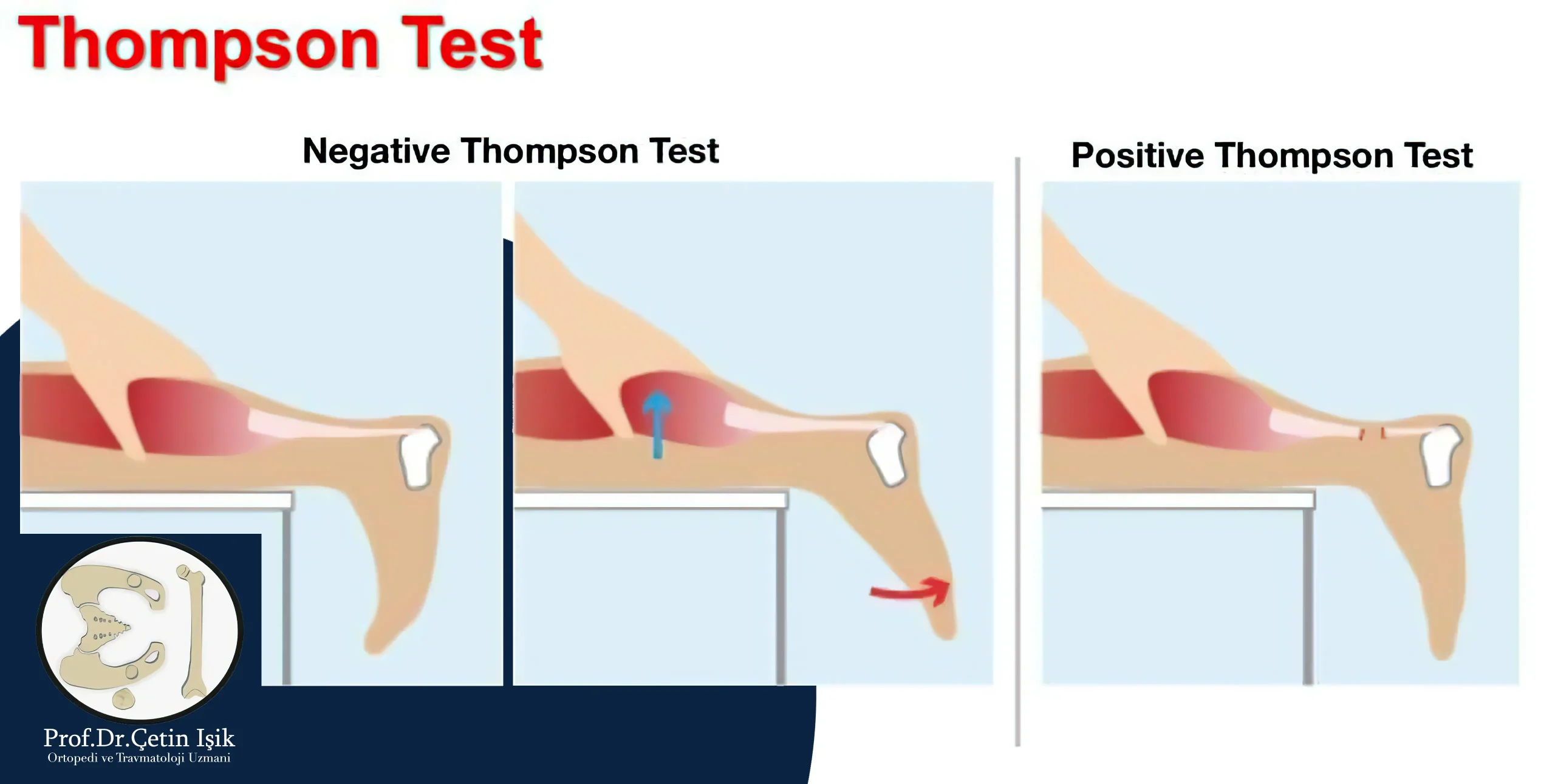 Image showing the Thomson test method for diagnosing Achilles tendinitis