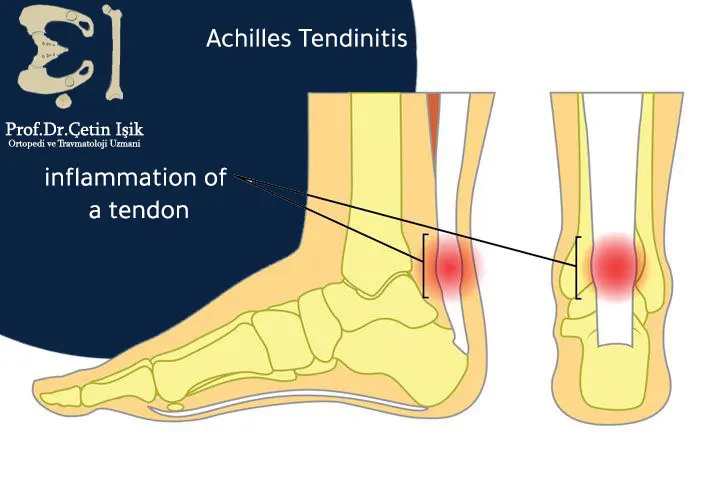 The location of the Achilles tendonitis is in the back of the heel