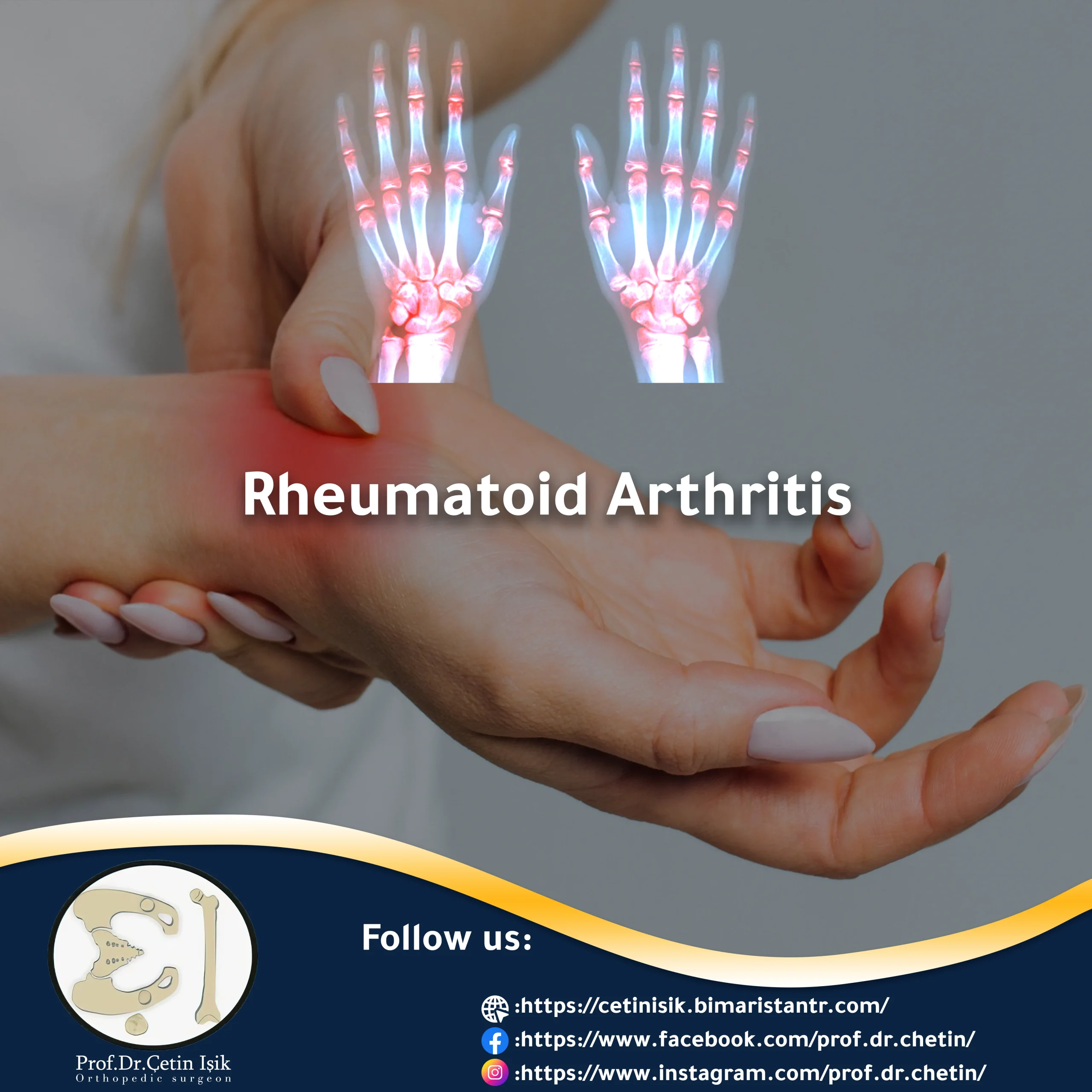 Picture showing rheumatoid arthritis in the fingers