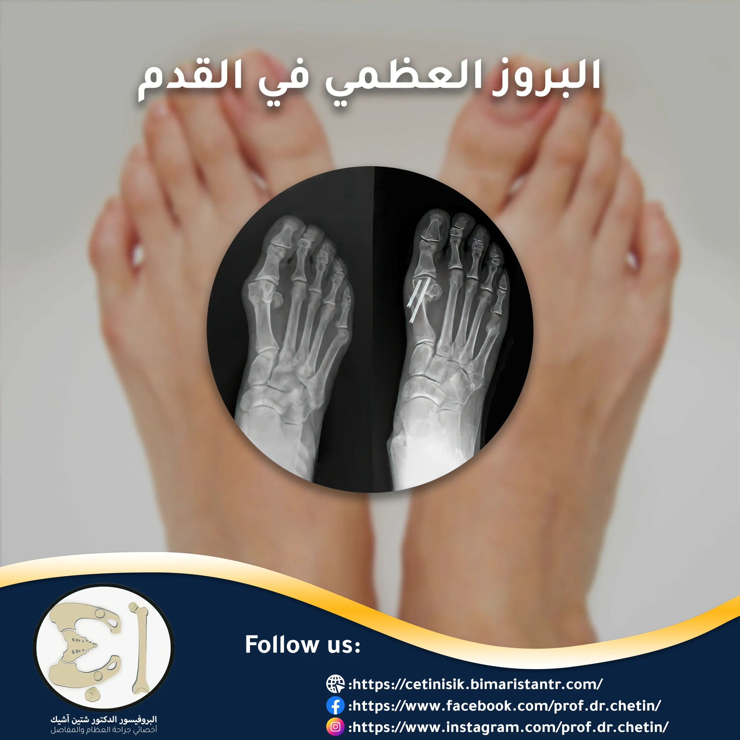 Bone protrusion in the foot, symptoms and treatment