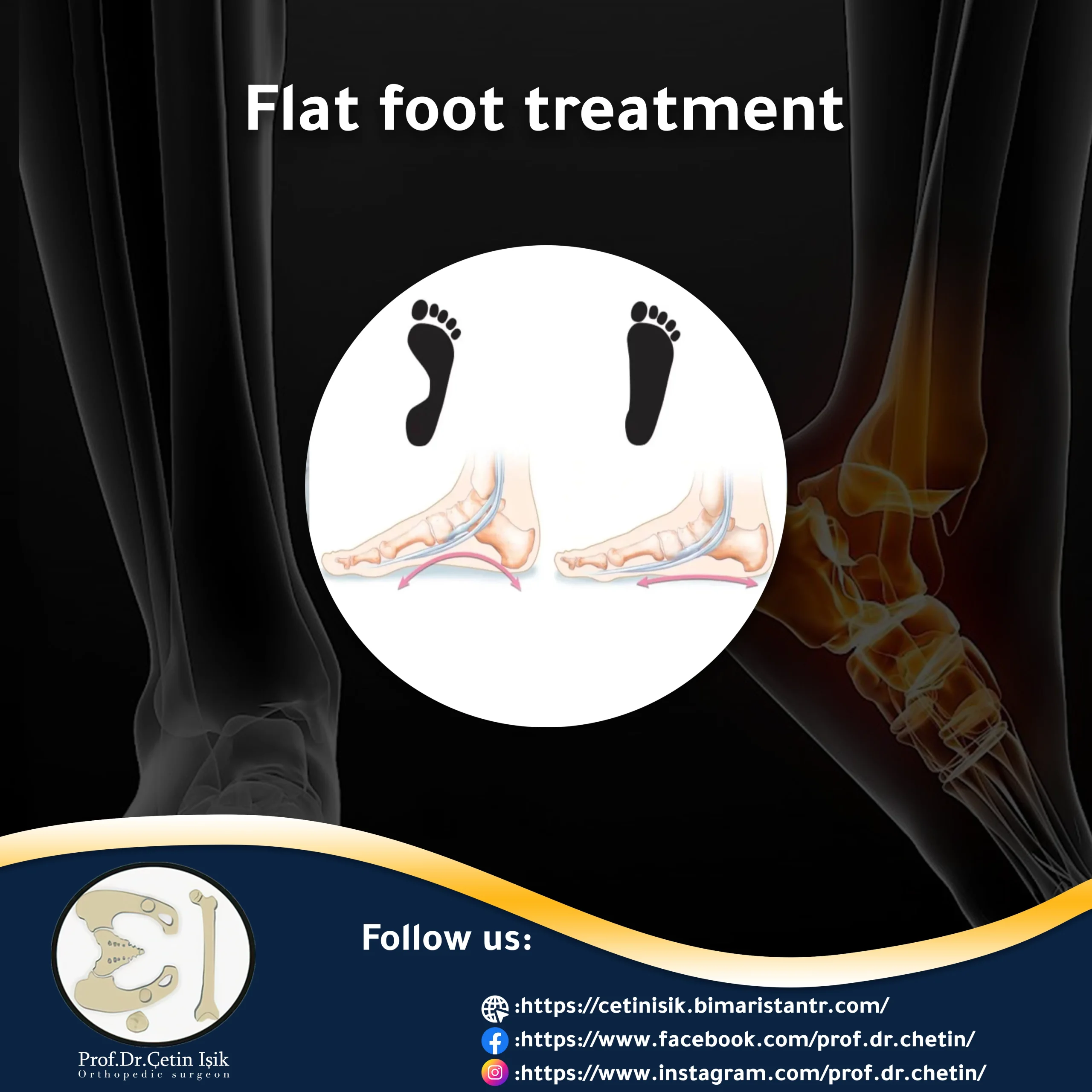 Flat foot treatment