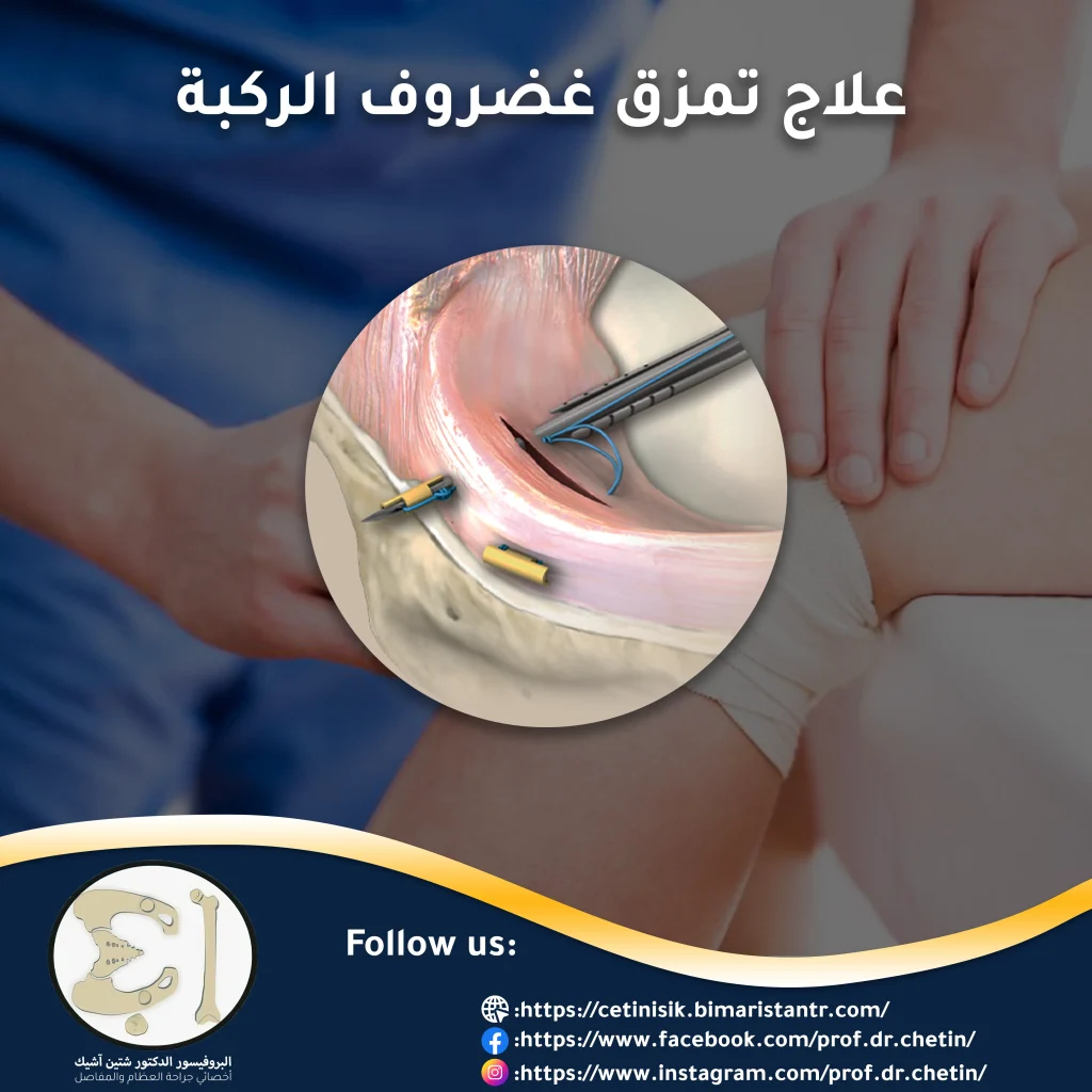 صورة توضح علاج تمزق الغضروف الهلالي في الركبة التي يتم فيها إصلاح الأنسجة الغضروفية المتمزقة أوو المتأذية في الركبة