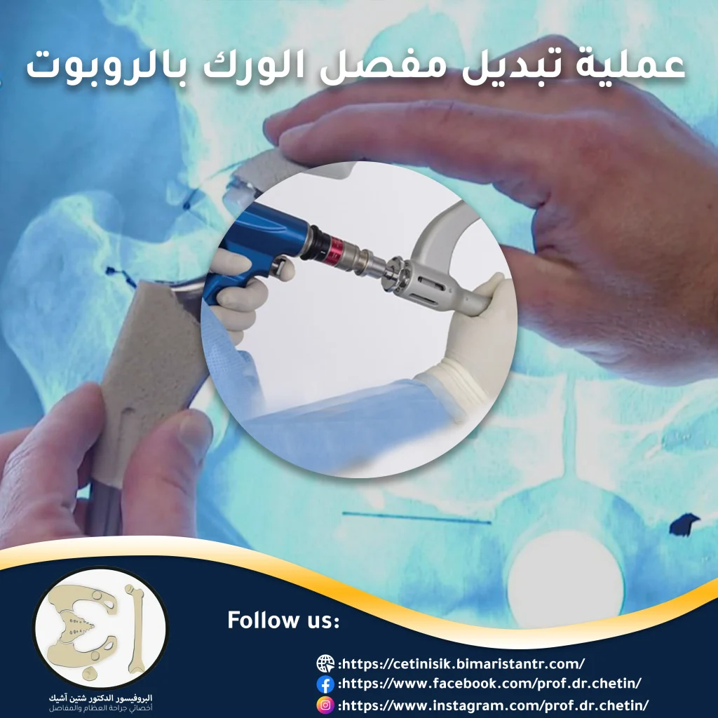 Robotic hip replacement article image