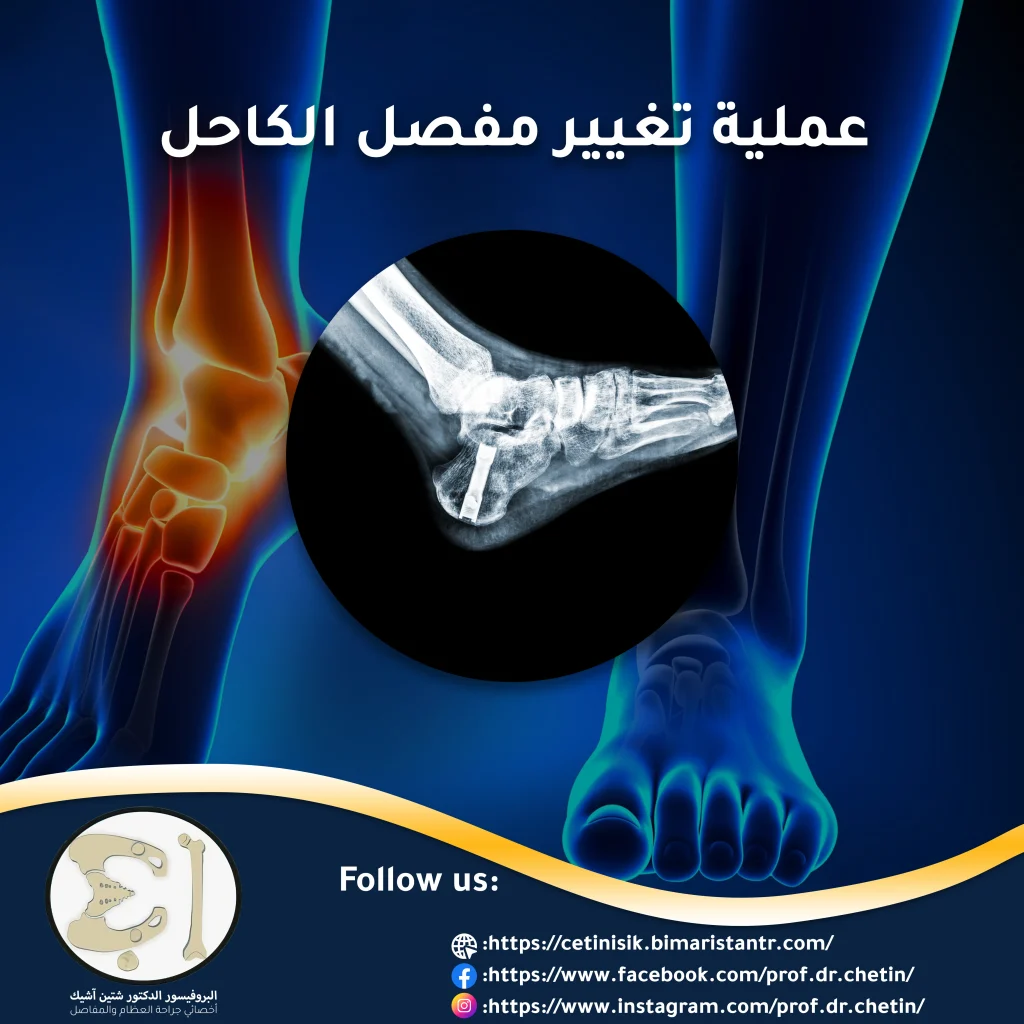 Image showing the ankle replacement procedure