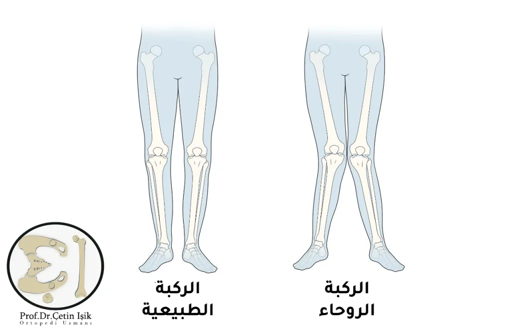 الفرق بين الركبة الروحاء والطبيعية، نلاحظ تلامس الركبتين مع تشكل مسافة بين الكاحلين عند الوقوف