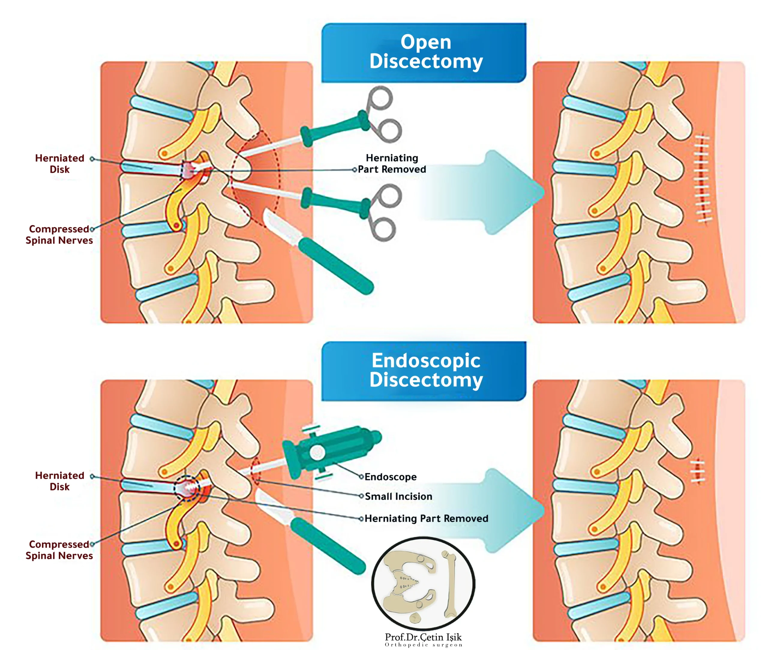 The difference between endoscopic herniated disc treatment and open surgery. The picture shows the size of the surgical incision in both cases.